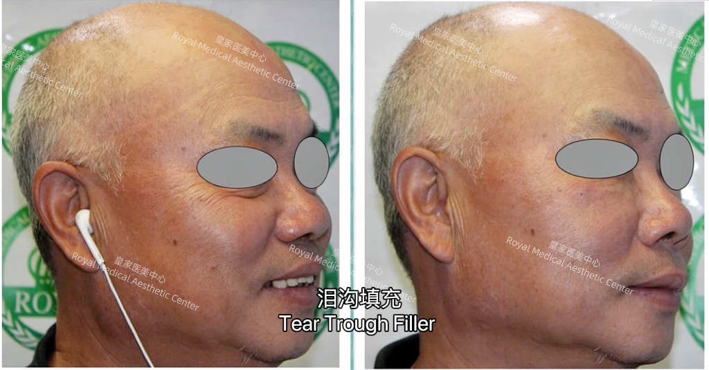 泪沟填充